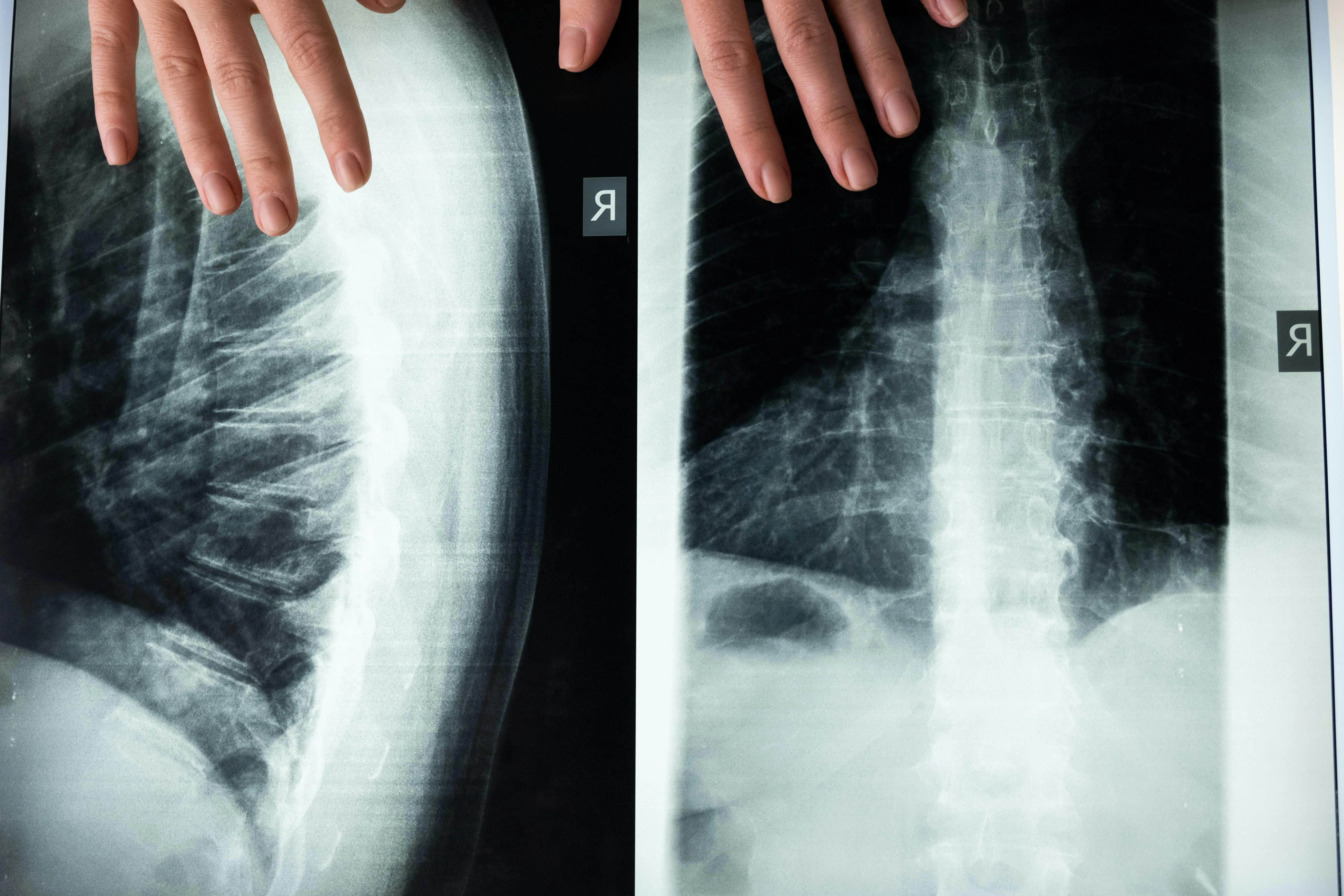 Pilates para dolor lumbar: guía responsable